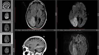Infarction with Hemorrhagic Transformation