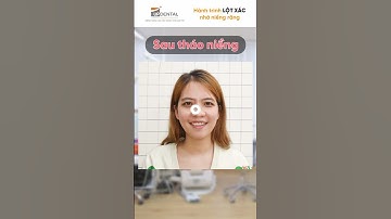 Hành trình LỘT XÁC nhờ niềng răng của Thùy Linh