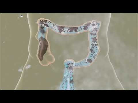 Видео: Хидротерапия на дебелото черво - отзиви, противопоказания, ползи