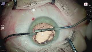 Ophthalmic surgery live 18+ Lukan Mishev