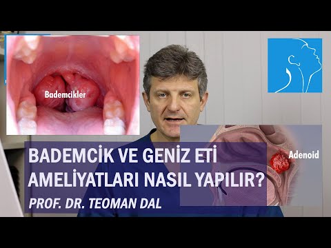 BADEMCİK VE GENİZ ETİ AMELİYATLARI NASIL YAPILIR | PROF. DR. TEOMAN DAL