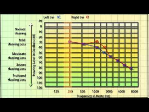 Wie ein Audiogramm lesen