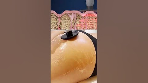 🍑Reduce the appearance of Cellulite using Radio Frequency