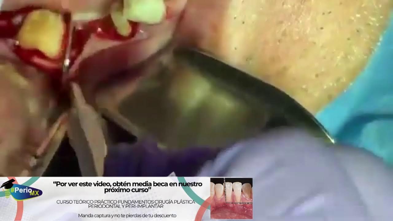 Retransmisión de procedimiento de alargamiento de Corona en el Segmento Posterior