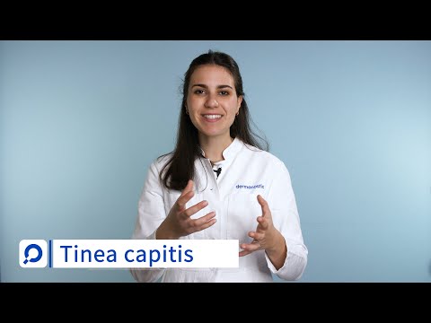 Tinea capitis - Ursachen, Symptome und Behandlung | dermanostic Hautlexikon