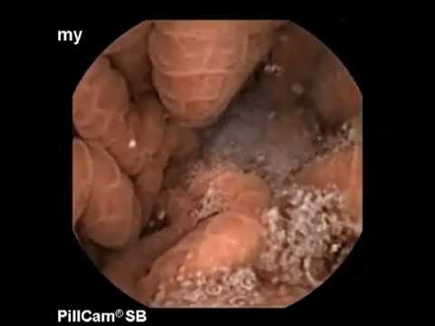 Capsule endoscopy in cirrhosis: Portal Gastropathy