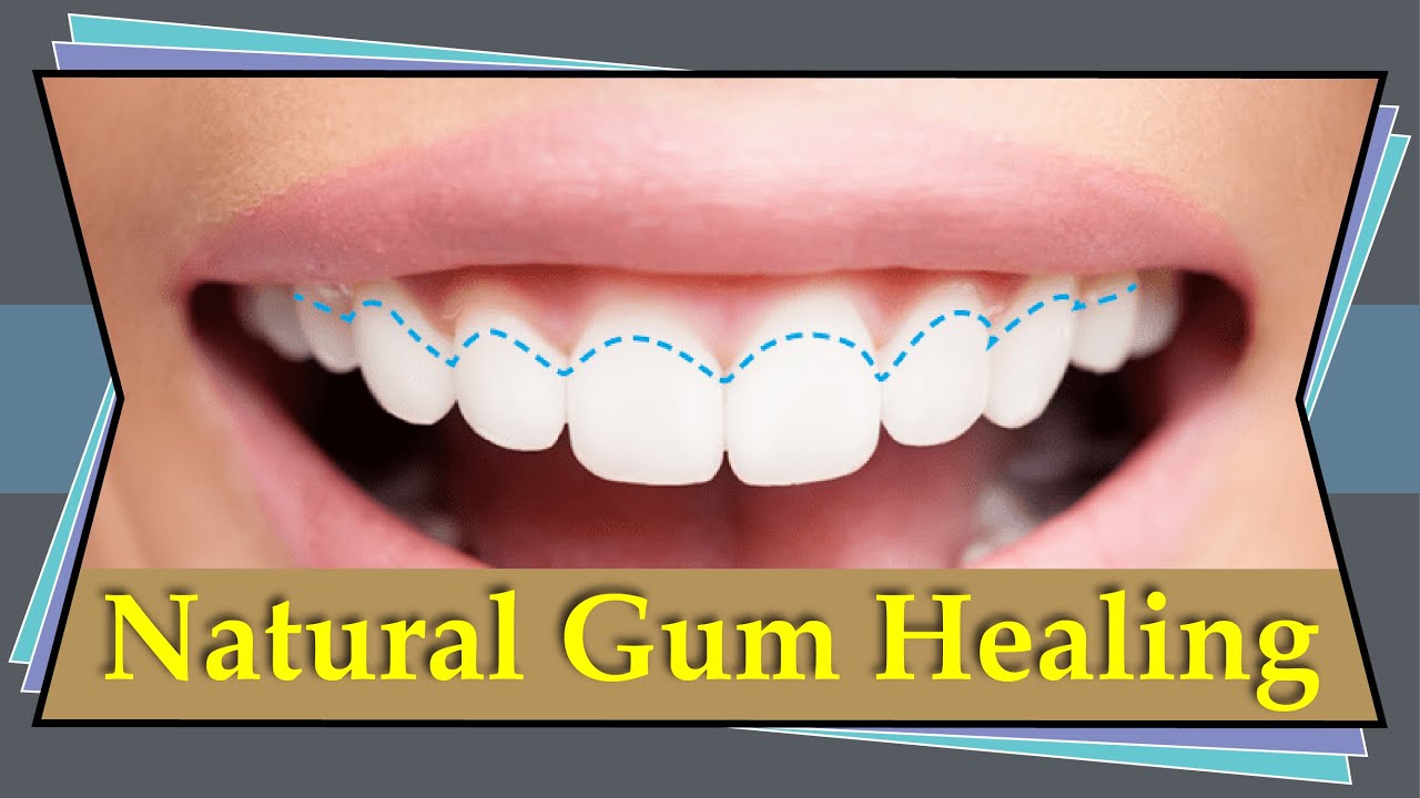 Heal Gums Natural Gum Healing Treatment At Home YouTube