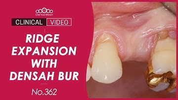 Ridge expansion for implant placement using densah bur [Dr.Cho Yongseok]