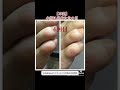 【卒業】小指に出来た魚の目【用賀フットケア】#魚の目 #フットケア