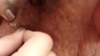 Squeezing Blackhead