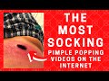 Pimple Popping - The Most Socking Pimple Popping Videos on the Internet