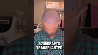 Perfect Hairline Restoration Result! #HairlineDesign #HairTransplant #BestResult