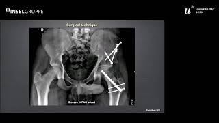 Sub-capital reorientation for SCFE with a minimum FU of 40 months | Paulo Rego (Session 7)