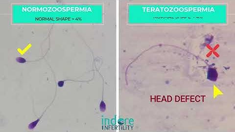 Teratozoospermia - Poor Morphology Sperms Comparison with Normal morhology sperms - Normozoospermia