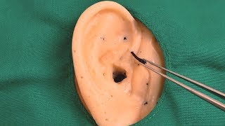 Removing stones from ears 2 (Sub ✔)RoleplayENT ASMR Explosive Audiovisual Tingle