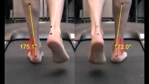 Gait video posterior with drawing.wmv