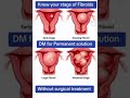 Stages of Fibroids. 🌸#shorts #ytshorts #viralshorts #trendingshorts #youtubeshorts #fibroids #viral