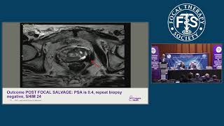 FTS 15 - Day 3 - Salvage Focal Therapy Post Radiation FTS 15 - Day 3 - Salvage Focal Therapy Post Radiation