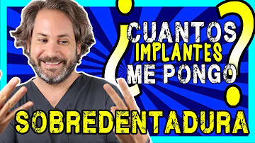 ¿Cuántos implantes dentales se necesitan para una dentadura postiza?