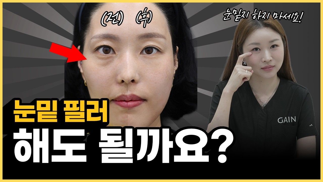 눈밑 꺼짐, 다크서클 케이스별로 총정리 해드립니다! 눈밑 시술 받기 전 필수 시청 하세요! ㅣ10년차 의사가 밝히는 눈밑필러 시술