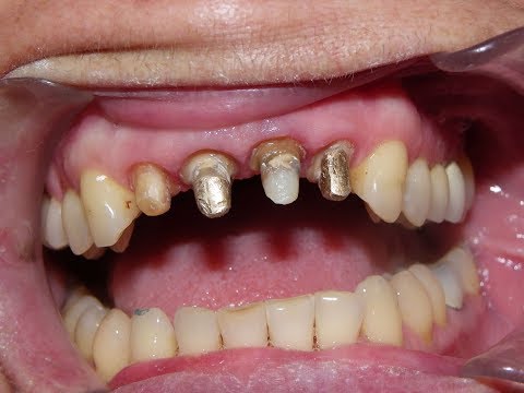 ใส่เดือยฟัน+ครอบฟัน (รักษารากฟัน) Post Core Crown Procedure