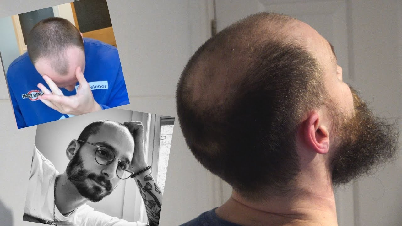 These Balding Men Grew Out Their Hair for 25 Days YouTube