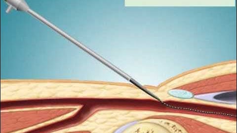 Cardiac Catheterization via Femoral Artery