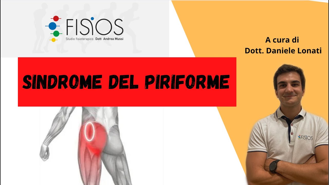 Trattamenti Efficaci per la Sindrome del Piriforme: Riabilitazione e Terapia Fisica