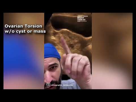 Image of Ovarian Torsion