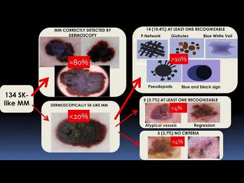 Video: Seborrheic Keratosis Vs. Melanoma: Kjenn Fakta