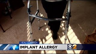 Dr. Max Gomez: Allergic Reactions To Knee Implants