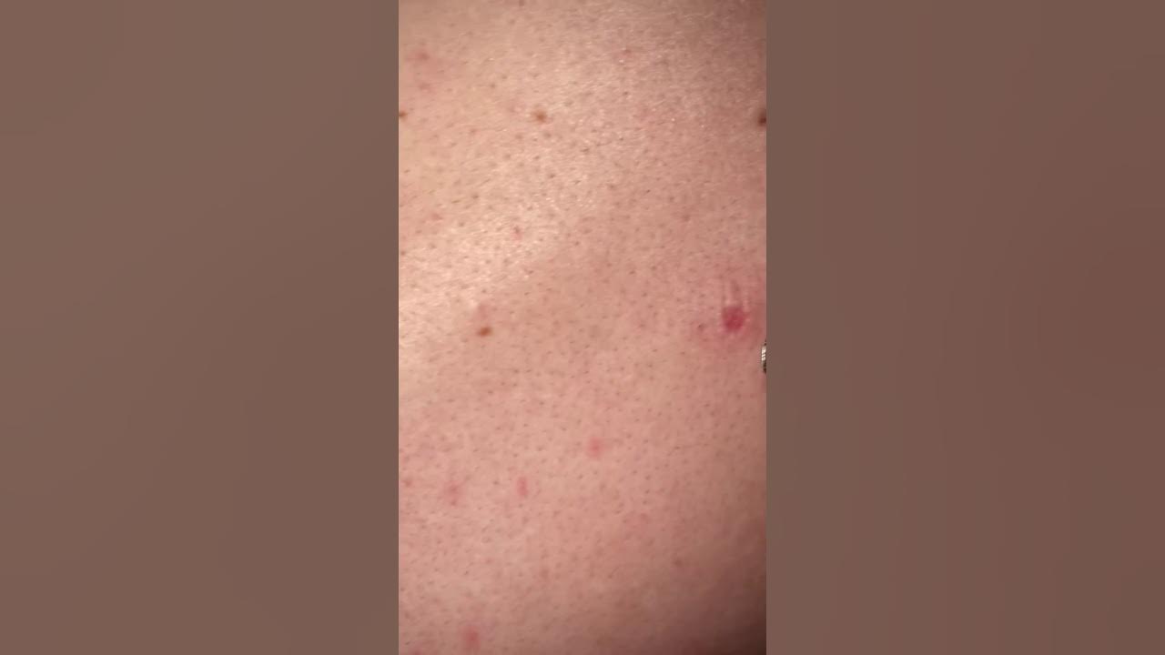 Back pimple popping YouTube