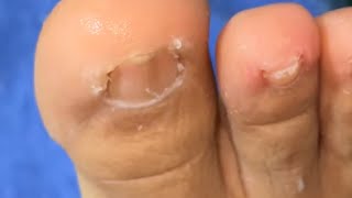 Ep_8719 Foot nails skin removal �...