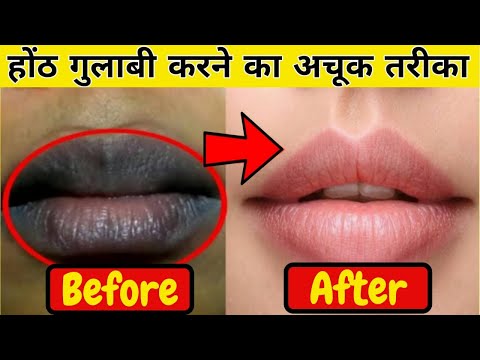 वीडियो: खोपड़ी की खुजली से छुटकारा पाने के 3 तरीके