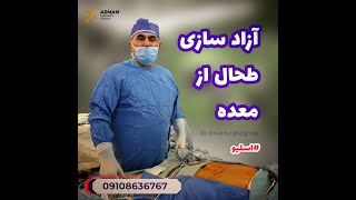آزاد سازی طحال از معده در عمل جراحی اسلیو معده دکتر ناصر یاهو