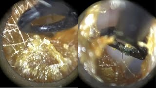 176 - Caramel Sticky Ear Wax Removal with Rai Curette & Microsuction using the WAXscope®️