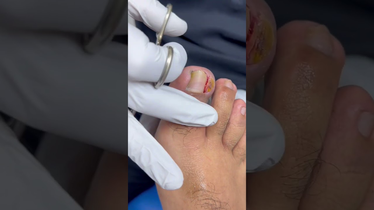 5. ¿Cobran un precio adicional por la eliminación de callos o durezas en los pies?