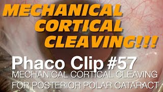Phaco Clip #57 - Mechanical Cortical Cleaving For Posterior Polar Cataract screenshot 2