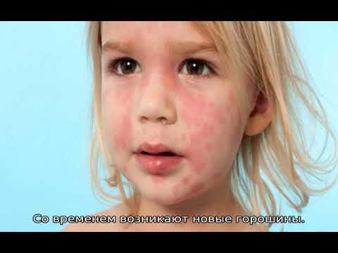 Красные пятна на теле у ребенка