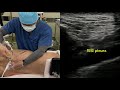 超音波ガイド下胸部傍脊椎ブロック Thoracic Paravertebral block (Th6/7) by Dr. Chonmage