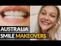 Transform your smile w australia smile makeovers no dentist affordable dental veneers