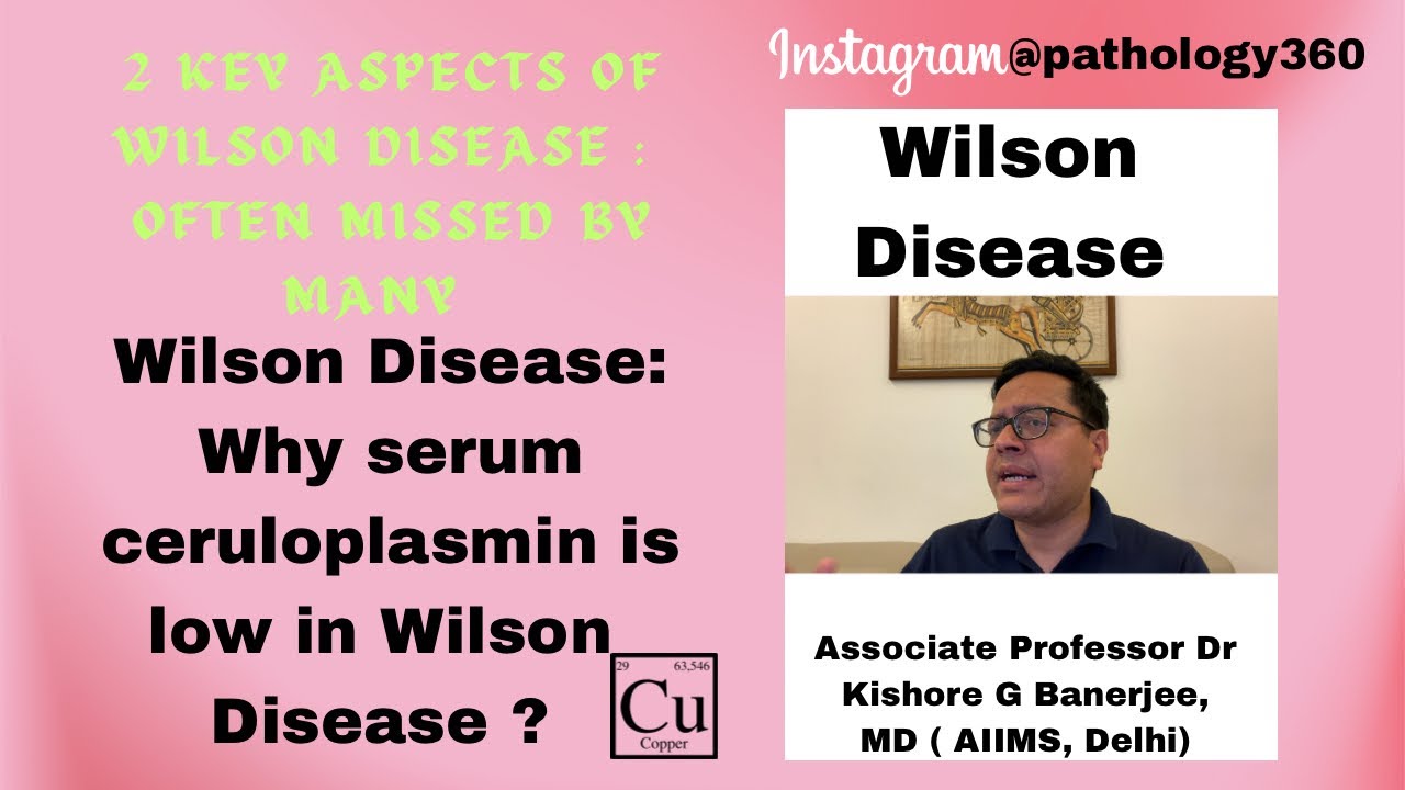 Why Serum Ceruloplasmin is low in Wilson Disease? 2 key features of 