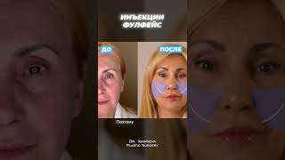 Уколи проти зморшок. Підготовка до процедури Full Face. Як проходить процедура ботокс фулфейс?
