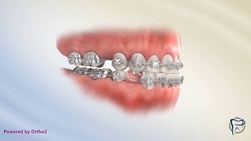 Fixing Class III Bite (Extractions)