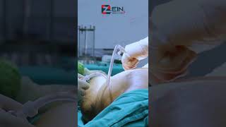 عملية شفط الدهون في مشفى زين باسطنبول تركيا | احدى أكثر عمليات التجميل شيوعاً مع نتائج رائعة