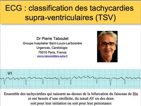 Vidéo: Rythme Auriculaire Synchronisé Aux Ondes R Chez Les Patients Pédiatriques Atteints De Tachycardie Ectopique Jonctionnelle Postopératoire: L'intervalle Auriculo-ventriculaire é