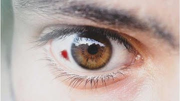 Eye Bleeding: What You Need to Know | Tita TV