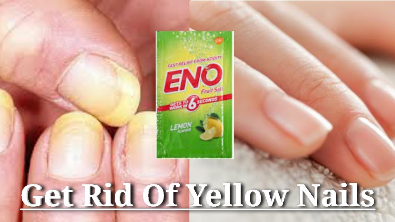 How to Get Rid Of Yellow Nails Home Remedies for YELLOW NAILS Appreciateyourself YouTube