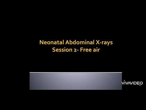 Neonatal abdominal Xrays- free air