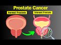 The Silent Threat: Prostate Cancer Explained